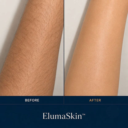 IPL Laser Hair Removal Device for Women – At-Home Permanent